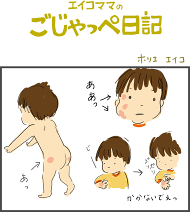 じんましん＿１歳８ヶ月